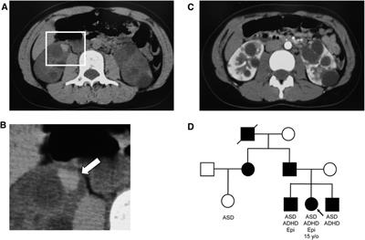 Case Report: Guanfacine and methylphenidate improved chronic lower back pain in autosomal dominant polycystic kidney disease with comorbid attention deficit hyperactivity disorder and autism spectrum disorder